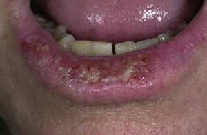 Плоскоклеточный рак губы